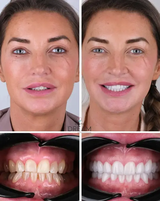 Before and after dental smile case 13