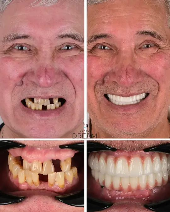 Before and after dental smile case 15