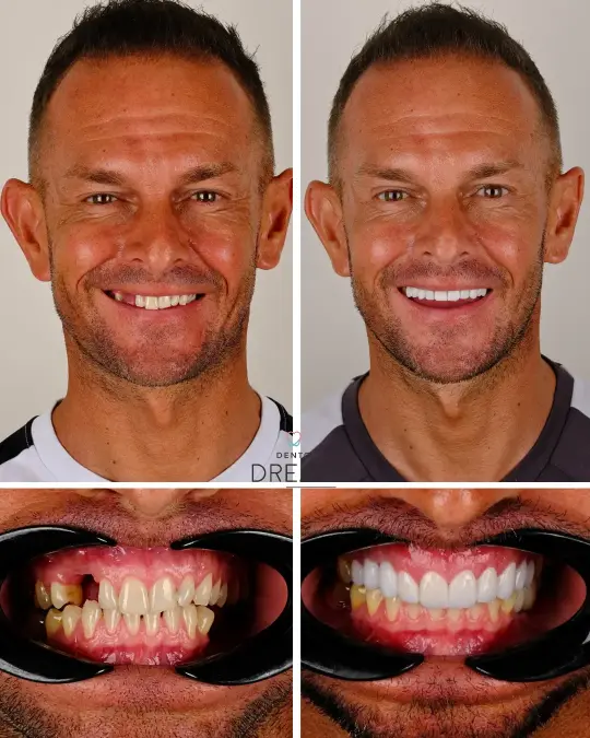 Before and after dental smile case 19