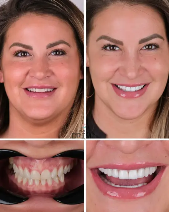 Before and after dental smile case 2