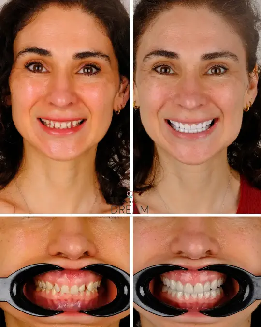 Before and after dental smile case 22