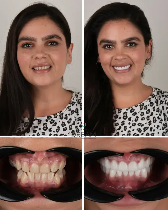 Before and after dental smile case 23