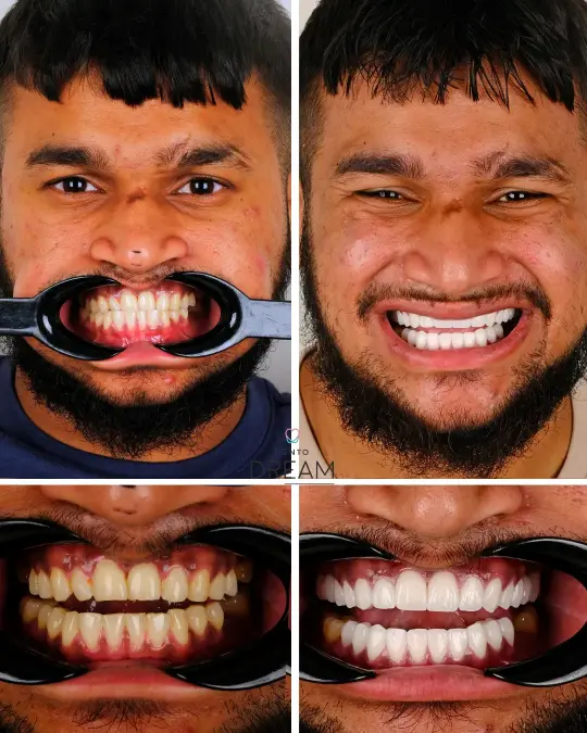 Before and after dental smile case 30