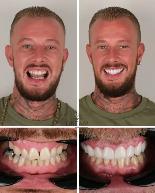 Before and after dental smile case 4