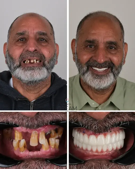 Before and after dental smile case 7