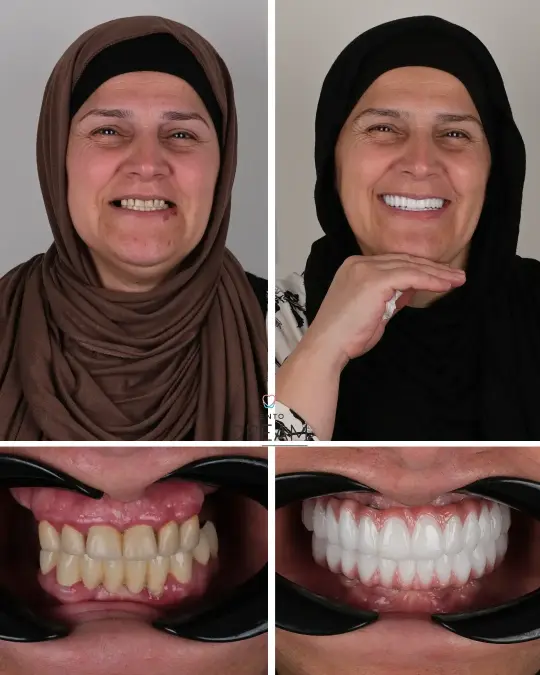 Before and after dental smile case 9